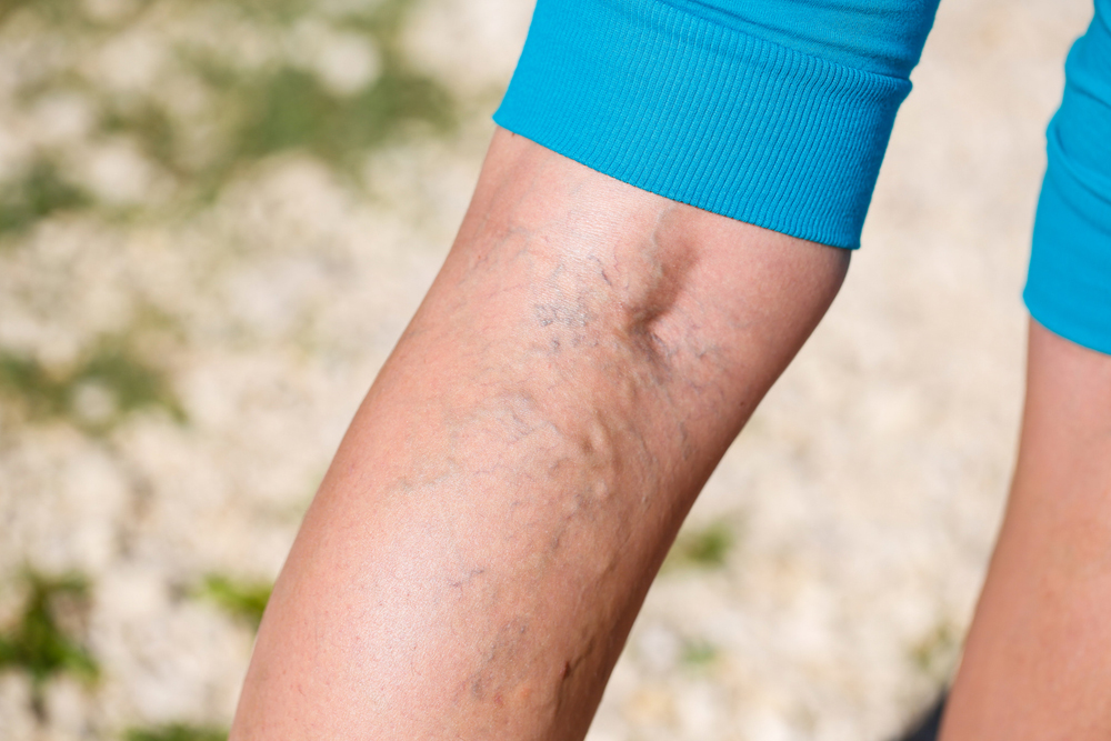 What Does a Damaged Vein Feel Like?