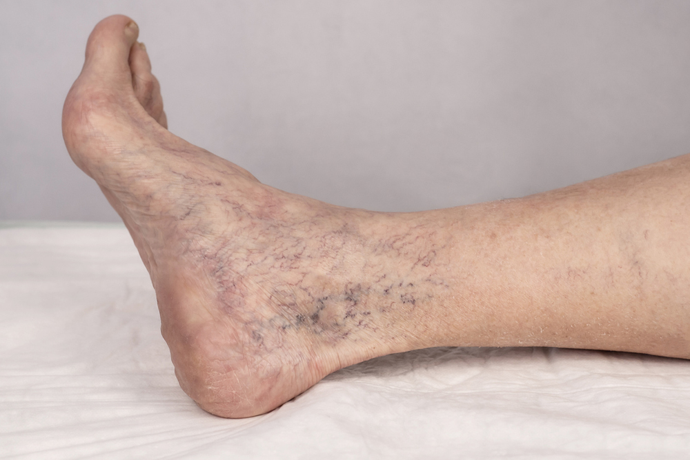 Am I Too Old to Treat My Varicose Veins?